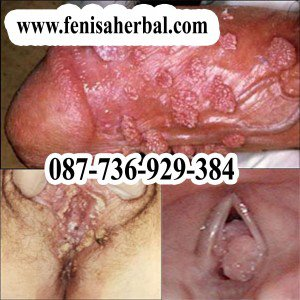 Illustration for article titled Obat Kutil Kelamin